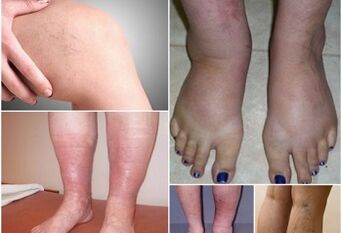 Foto di manifestazioni di vene varicose sulle gambe