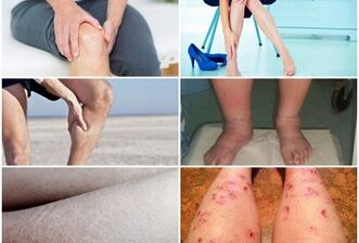 Sintomi di vene varicose sulle gambe