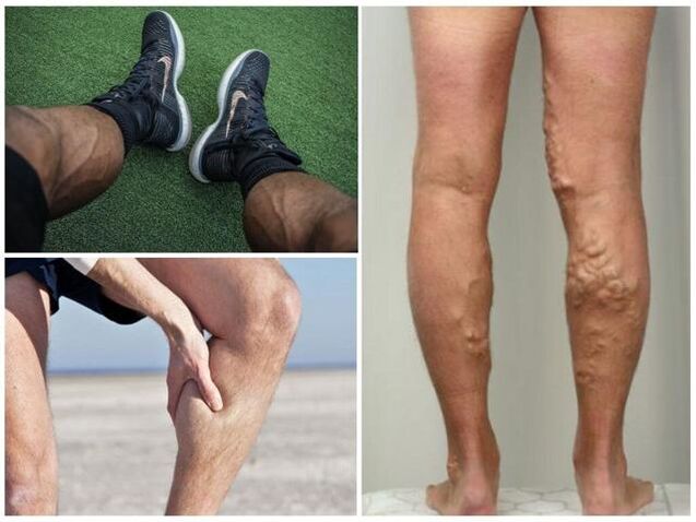 Come appaiono le vene varicose sulle gambe degli uomini