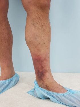 Complicazioni delle vene varicose negli uomini