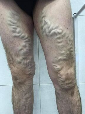 vene varicose maschili trascurate