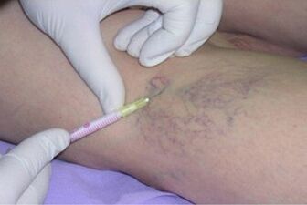 La scleroterapia come metodo di trattamento delle vene varicose