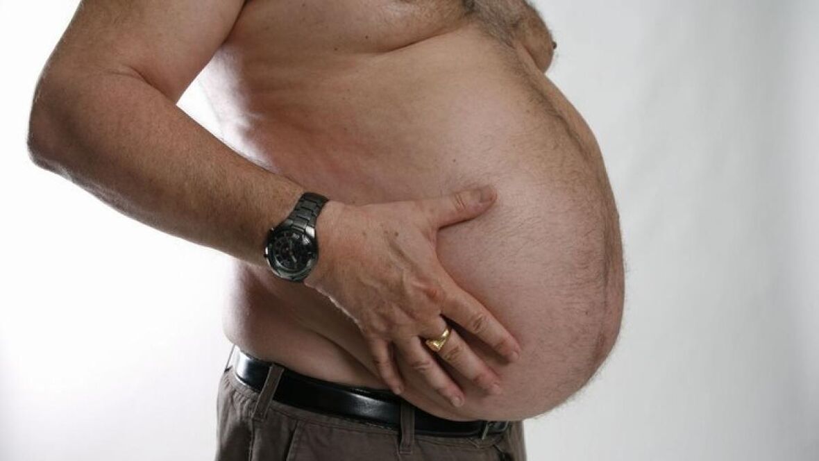 L'obesità come causa dello sviluppo delle vene varicose