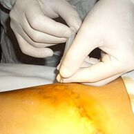 La miniflebectomia è il trattamento più cosmetico per le vene varicose