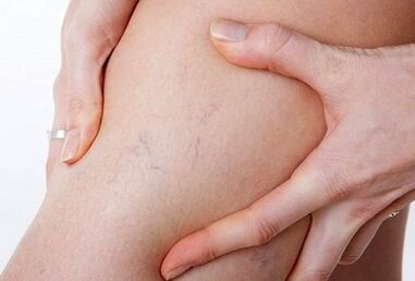 Azioni proibite per le vene varicose