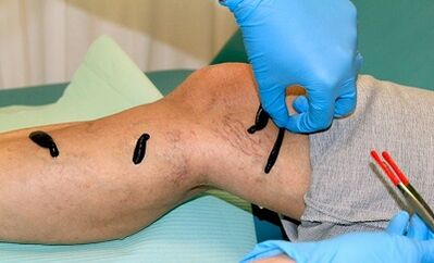 Hirudoterapia per vene varicose