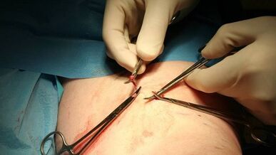 Flebectomia per vene varicose