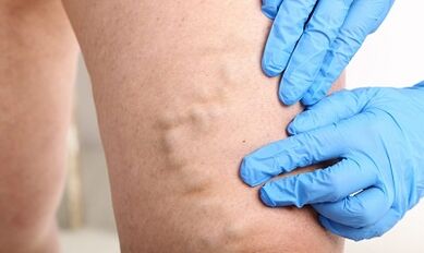 Vene varicose sulle gambe
