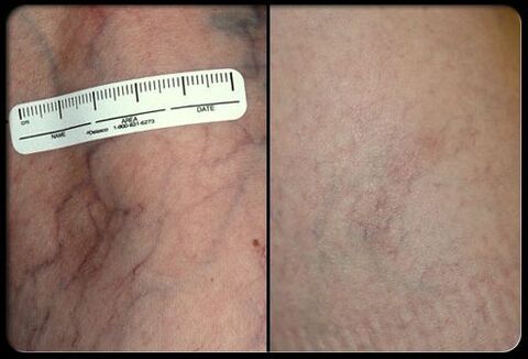 Prima e dopo la procedura di terapia laser