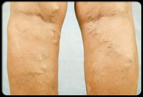 Vene varicose sulle gambe